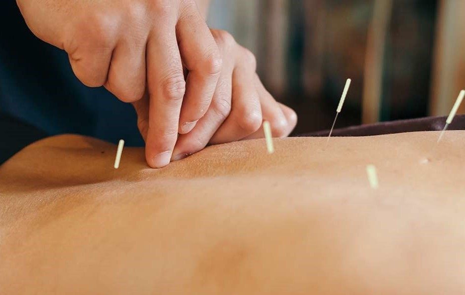   Acupuncture